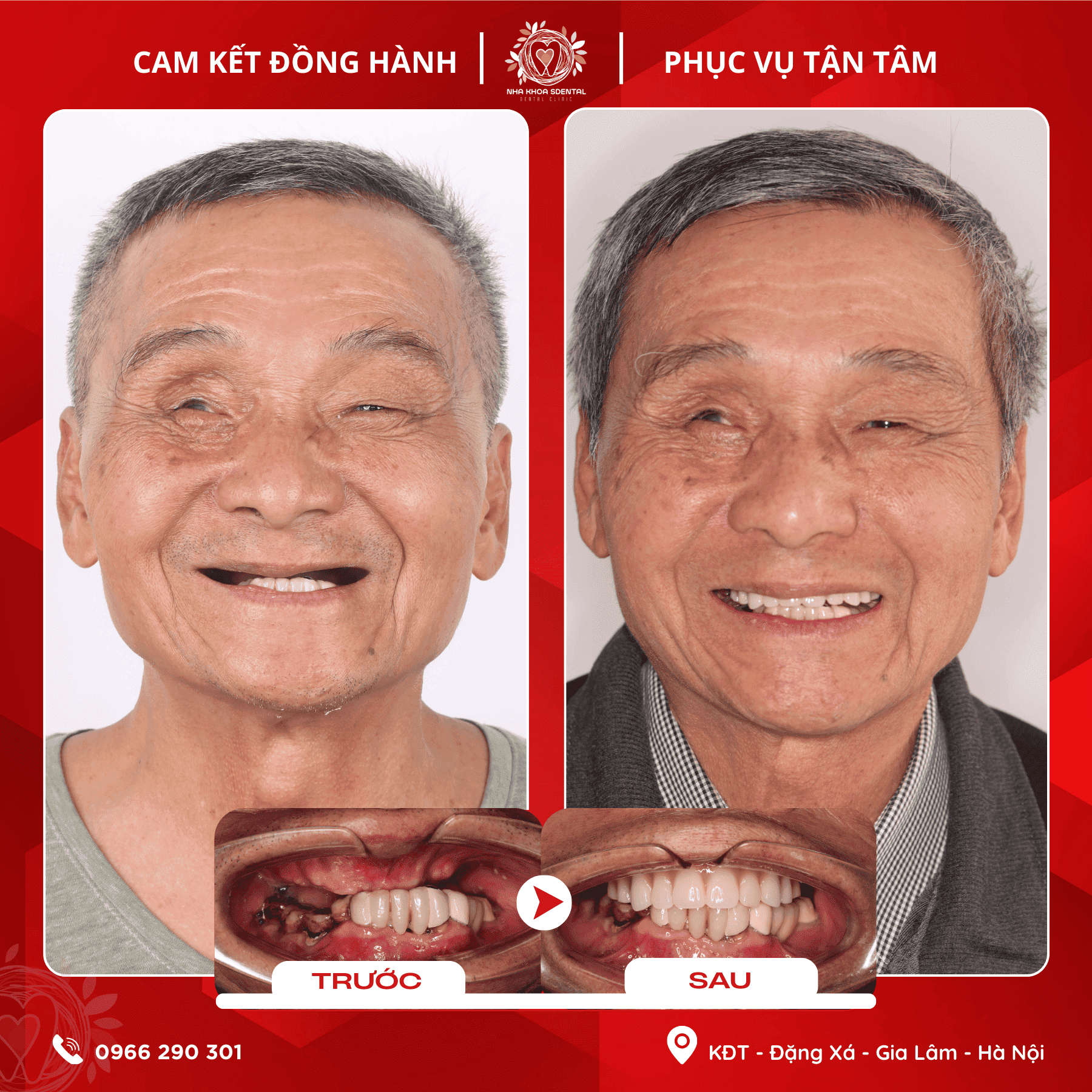 Trồng Răng Implant Toàn Hàm: Hành Trình Của Chú Doãn Đức Đồi Tại Nha Khoa S-Dental